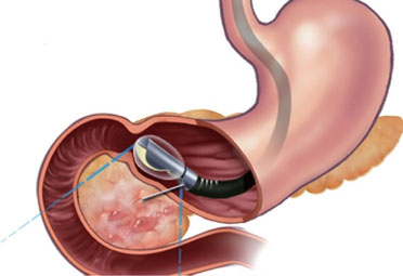 GI Procedures