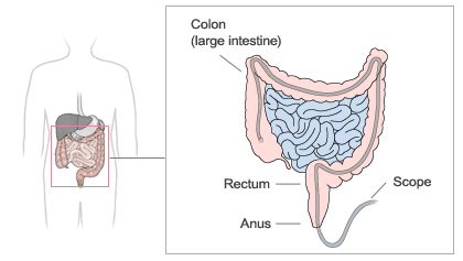 screening-for-colon-cancer