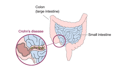 crohns