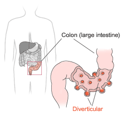 diverticular