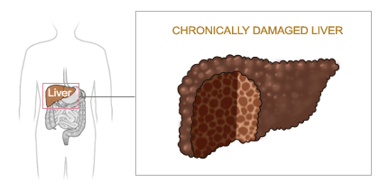 hepatitis