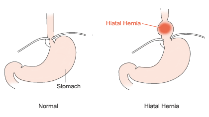 hiatal_hernia