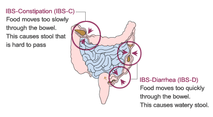 ibs-2