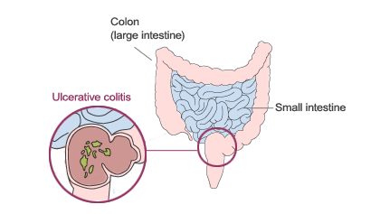 ulcerative-colitis